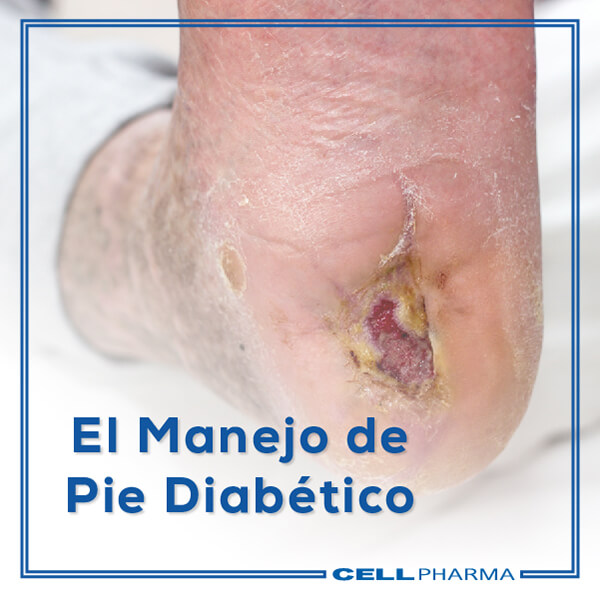 Actualidades en la Fisiopatología y el Manejo de Pie Diabético